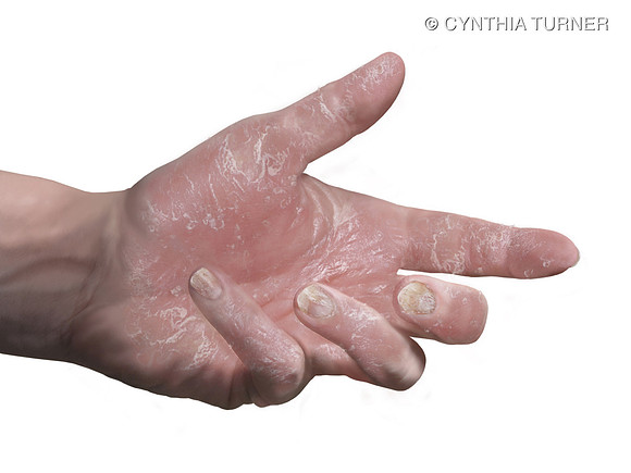 Response to Enbrel® (etanercept) Treatment - Baseline