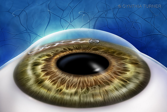 Hydrus® Microstent