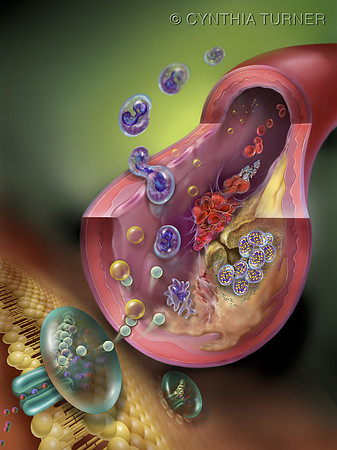 Hyperlipidemia 2