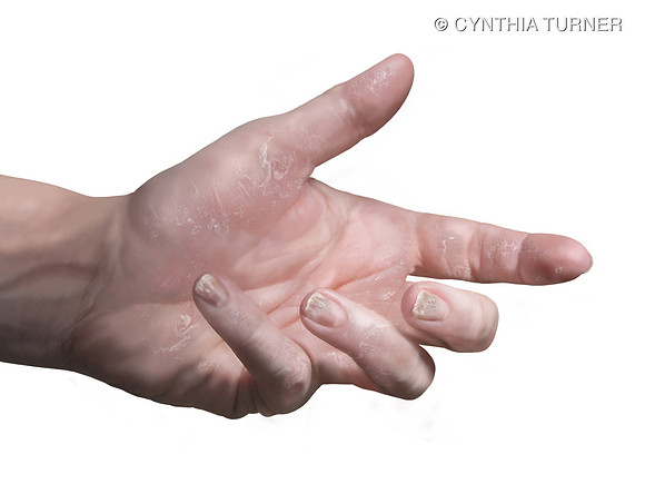 Response to Enbrel® (etanercept) Treatment - 12 Weeks
