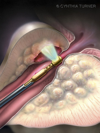 Benign Hypertrophic Hyperplasia Laser Ablation