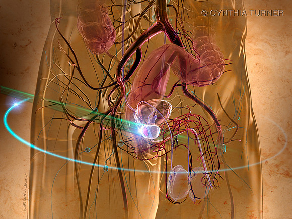 RapidArc Prostate Cancer Treatment