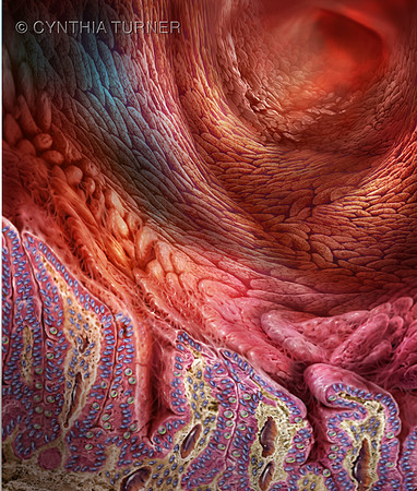Celiac Disease