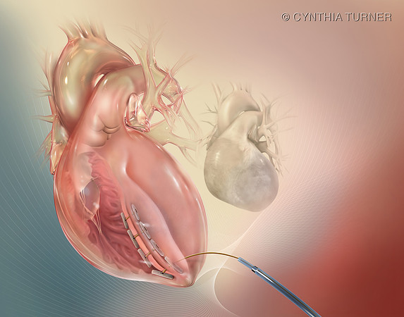 Bioventrix™ - The Plicated Heart