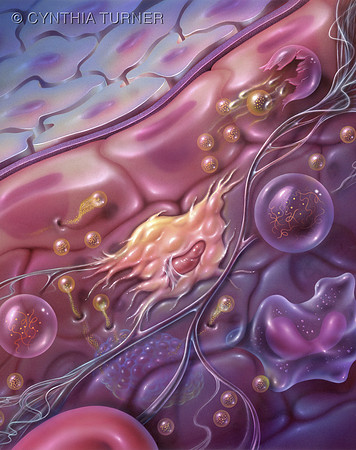 Hyperlipidemia