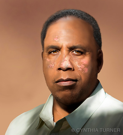 Compassionate Patient Portrait: Discoid Lupus